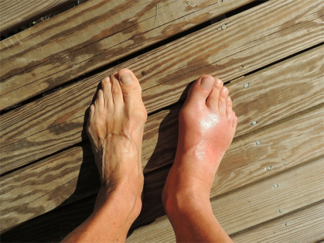 Tormented by gout, these are the signs