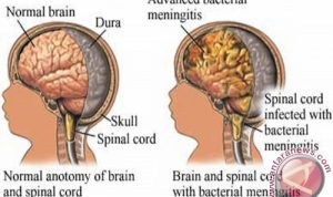 Meningitis menyerang lapisan selaput otak dan bisa mematikan (ANTARA/HO-WIikipedia)