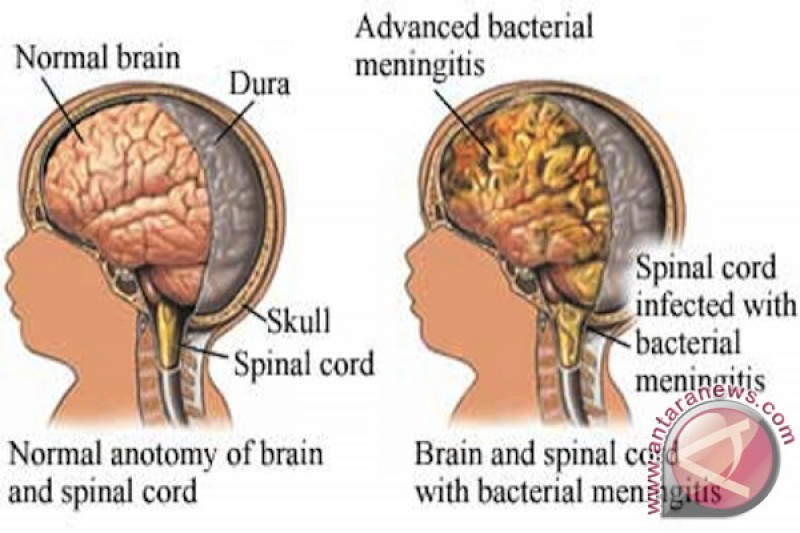 Meningitis menyerang lapisan selaput otak dan bisa mematikan (ANTARA/HO-WIikipedia)