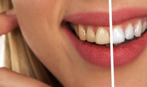 Idamkan Gigi Putih? 6 Makanan Ini Bisa Buat Gigi Anda Kuning