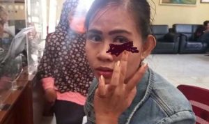 Korban KDRT Putri Fitria menunjukkan luka lebam dimatanya . (foto:Sumek)