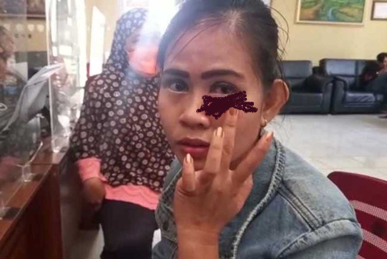 Korban KDRT Putri Fitria menunjukkan luka lebam dimatanya . (foto:Sumek)