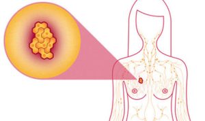 Hati-Hati Ini Gejala Kanker Payudara Yang Sering Dialami