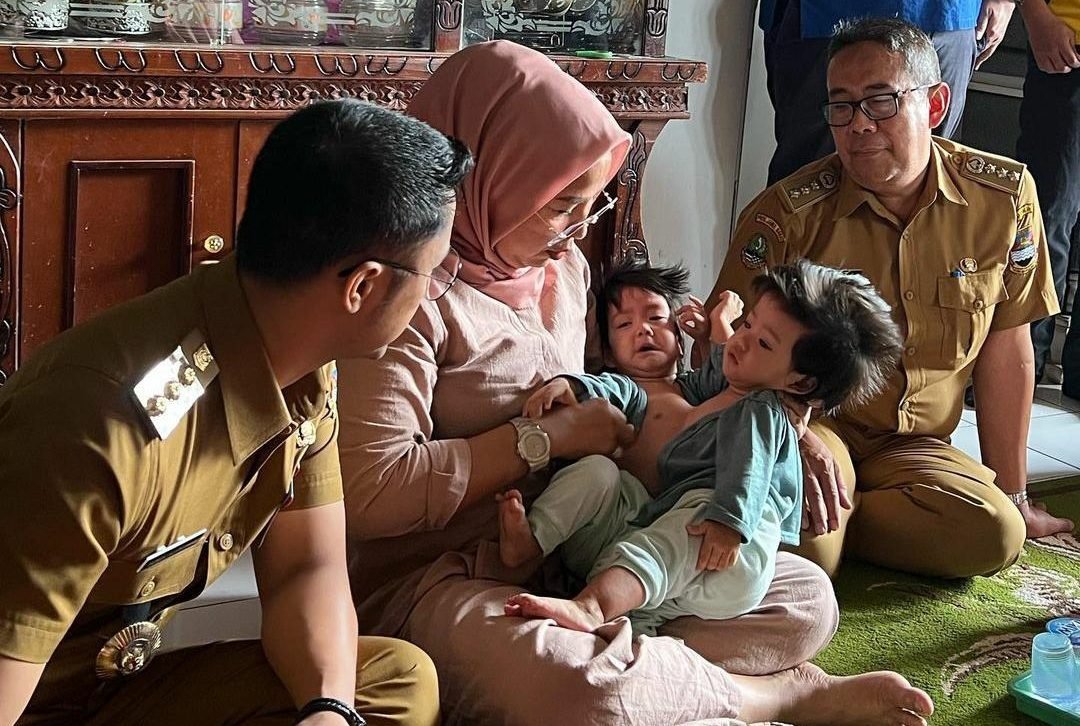 Bayi Kembar Siam, Bayi Kembar Siam, Bayi, Kembar Siang, Kabupaten Bandung Barat, Bupati Bandung Barat, Henky Kurniawan