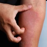 Rekomendasi obat gatal alami yang paling ampuh. (pixabay)