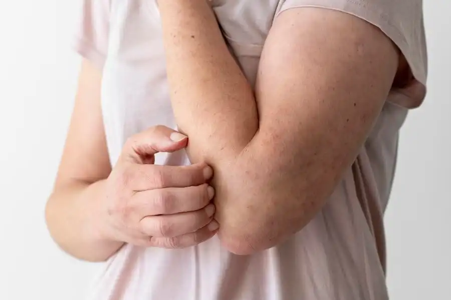 Obat Kudis Alami Paling Ampiuh Tanpa Efek Samping