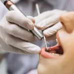 Apakah Scaling Gigi Dicover BPJS Kesehatan? Ini Penjelasannya