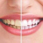 Senyum Percaya Diri! Ini Dia 6 Tips Cara Agar Gigi Tidak Kuning