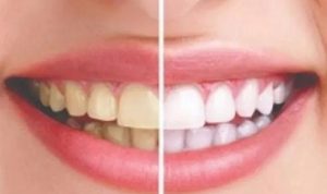 Senyum Percaya Diri! Ini Dia 6 Tips Cara Agar Gigi Tidak Kuning