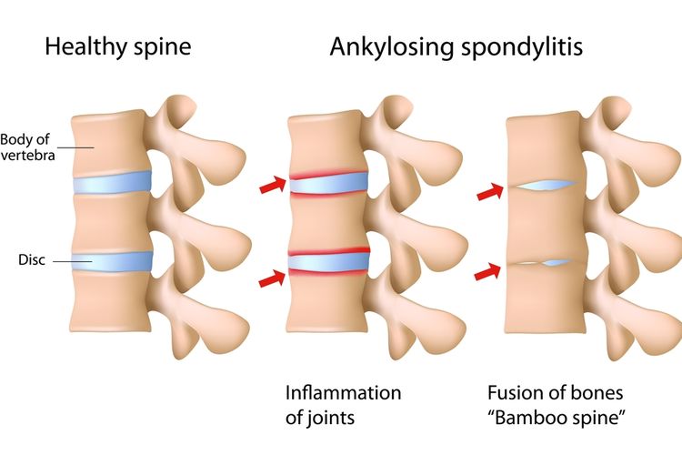 Kenali Ankylosing Spondylitis Penyakit "Manusia Kayu"