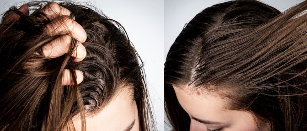 Tips Cara untuk Merawat Rambut Berminyak