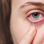 Berikut ini adalah penjelasan tentang penyebab, pengobatan dan cara mencegah mata bintitan