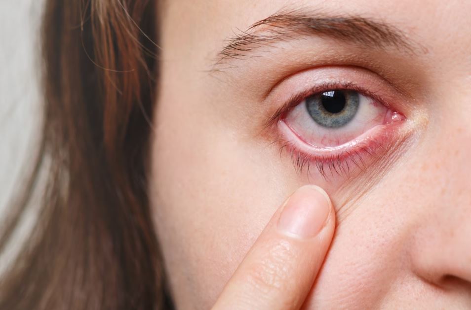 Berikut ini adalah penjelasan tentang penyebab, pengobatan dan cara mencegah mata bintitan