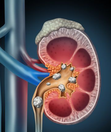Tanda Tanda Batu Ginjal!! Berikut Penyebab, Gejala, Dan Cara Mencegahnya
