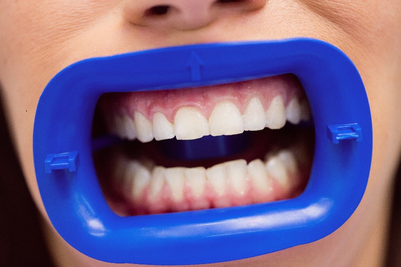 Selain Menyikat Gigi, Ketahui Tips Lain Merawat Gigi dan Mulut!