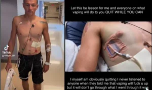 Kondisi Mason Midlleton yang mengalami paru-paru bolong karena Vape. (instgaram @fbgm_239)