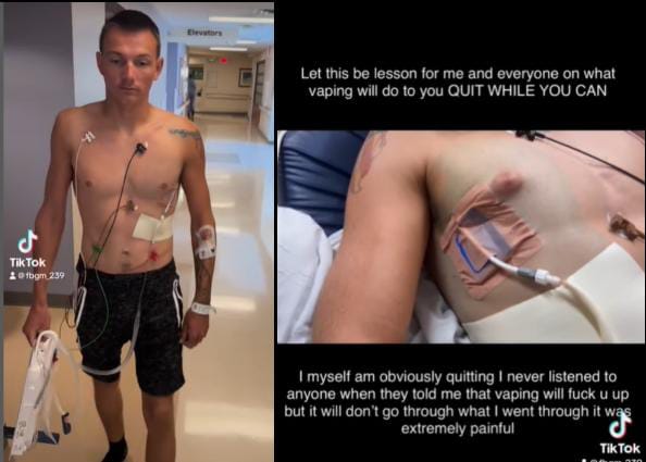 Kondisi Mason Midlleton yang mengalami paru-paru bolong karena Vape. (instgaram @fbgm_239)