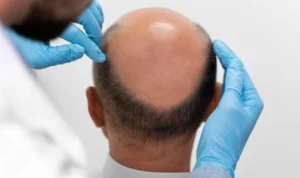 ILSUTRASI Cara mengatasi dan mencegah kebotakan rambut. (freepik)