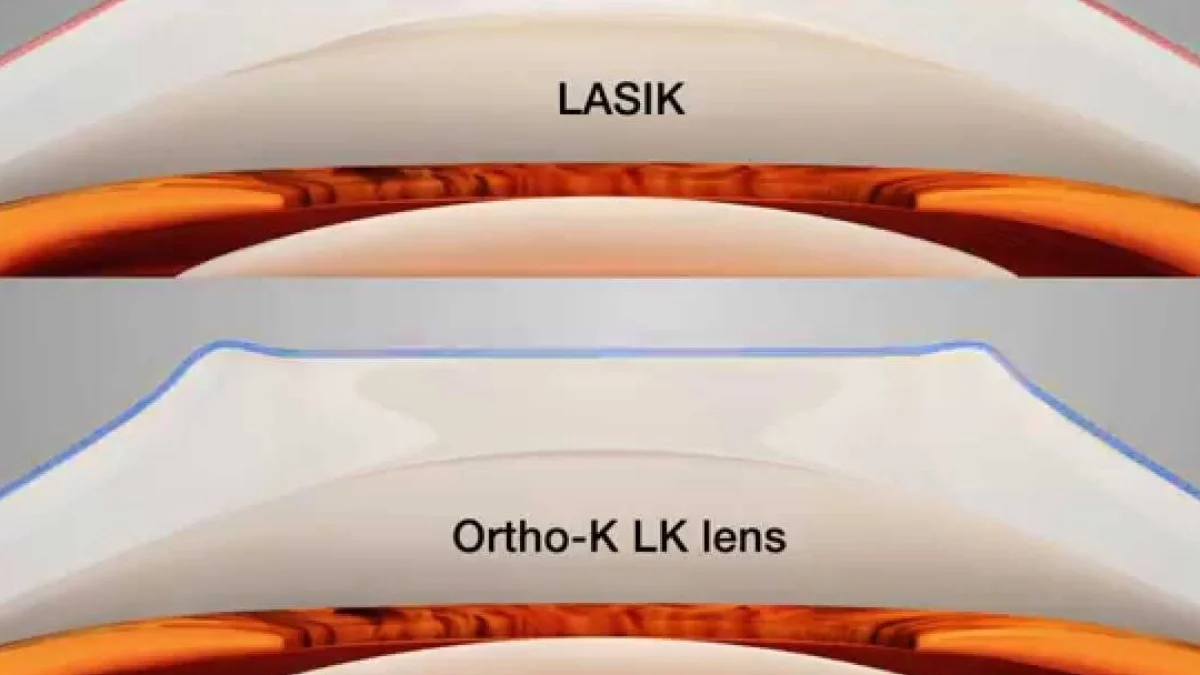 Apa Bedanya Antara Ortho-K dengan LASIK?