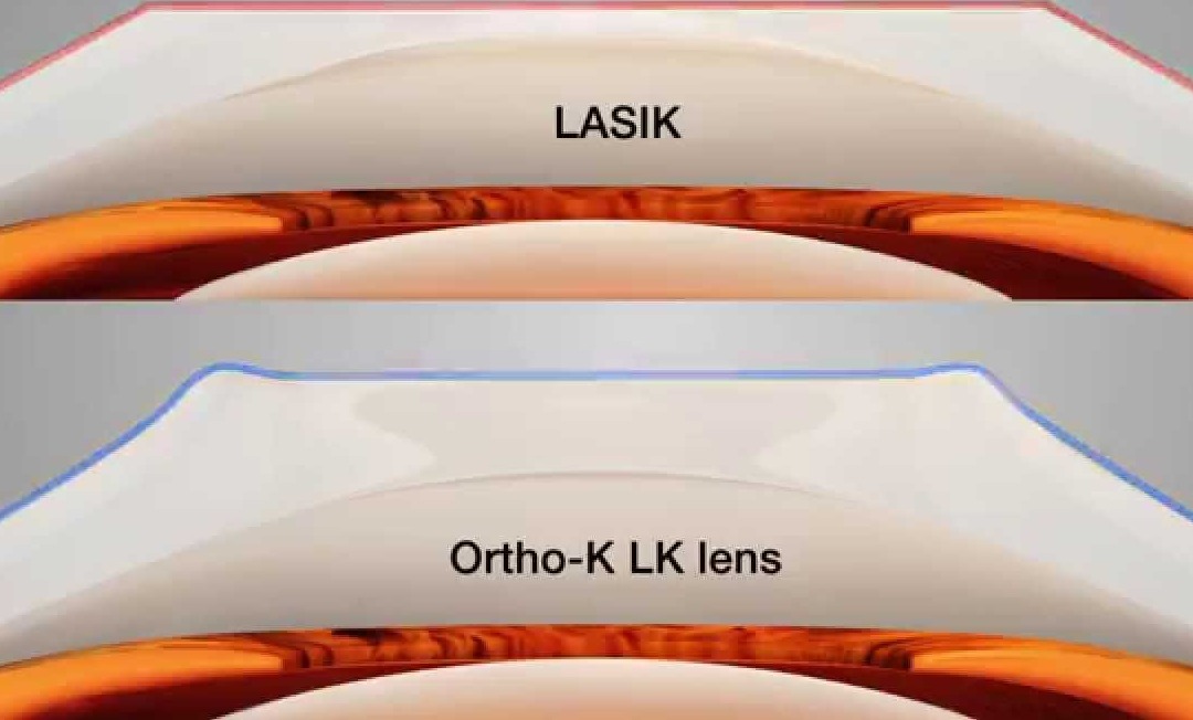 Apa Bedanya Antara Ortho-K dengan LASIK?